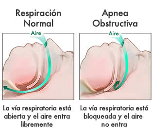 Apnea del sueño