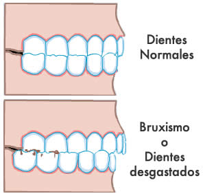 Bruxismo