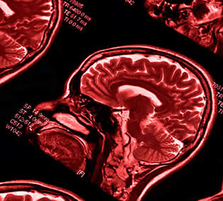 Síndrome Kleine-Levin Tratamiento